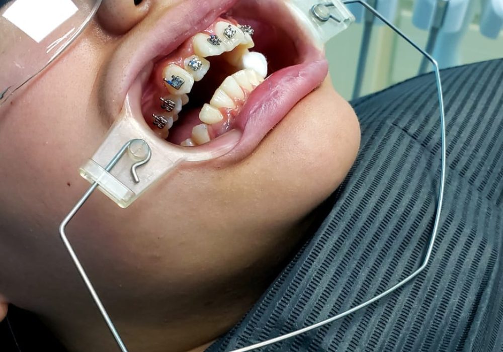 Dental braces