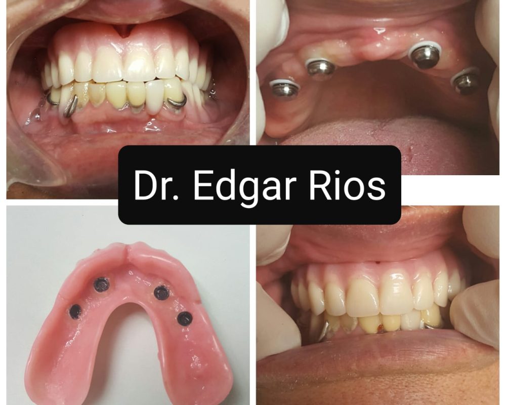 Denture supported by implant system