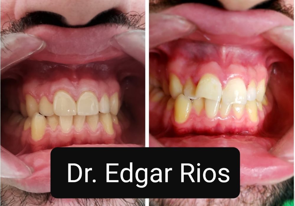 E-MAX Crowns # 8 & # 9 Dental services in algodones