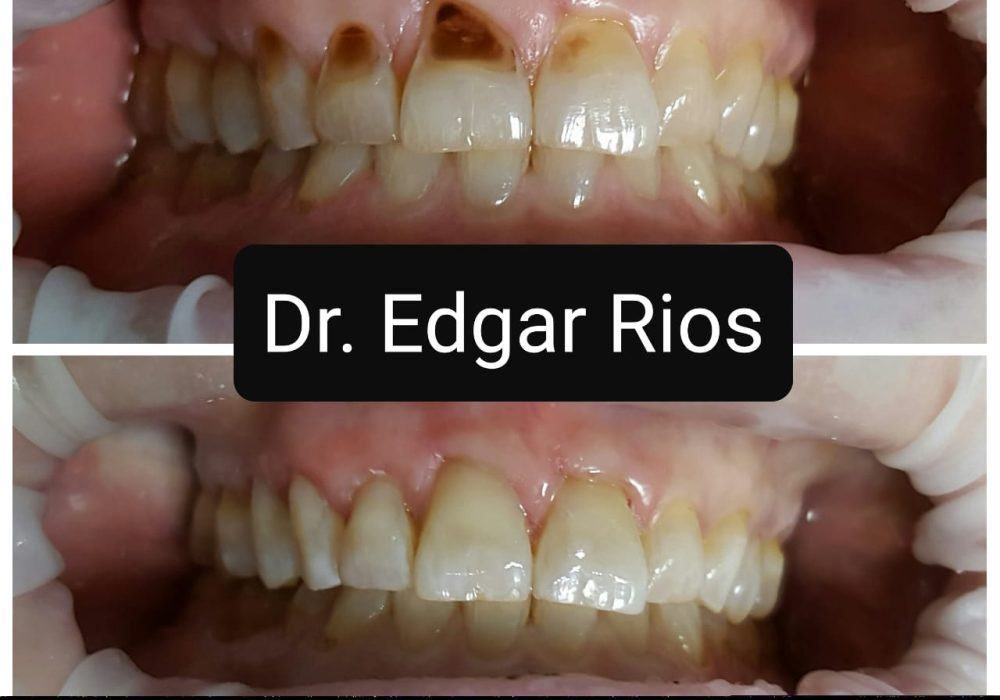 Fillings Dental services in algodones