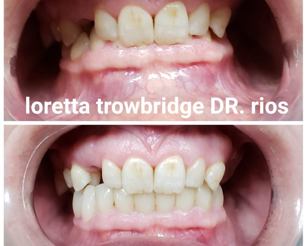 Lower area zirconia crowns